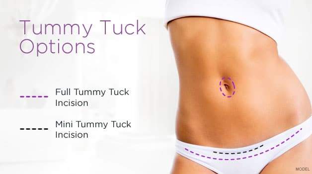 Abdominoplasty Surgery (Tummy Tuck Procedure)