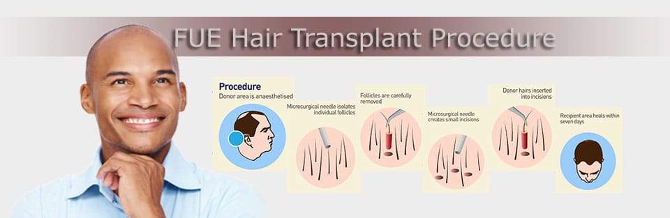 FUE hair transplant surgery