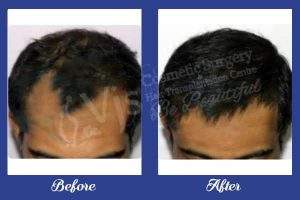 Hair Transplant before and after photos of Results in India