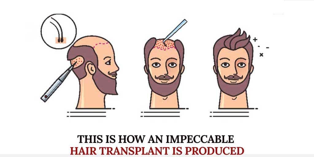 impeccable Hair Transplant