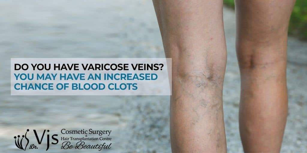 Do You Have Varicose Veins? You May Have an Increased Chance of Blood Clots