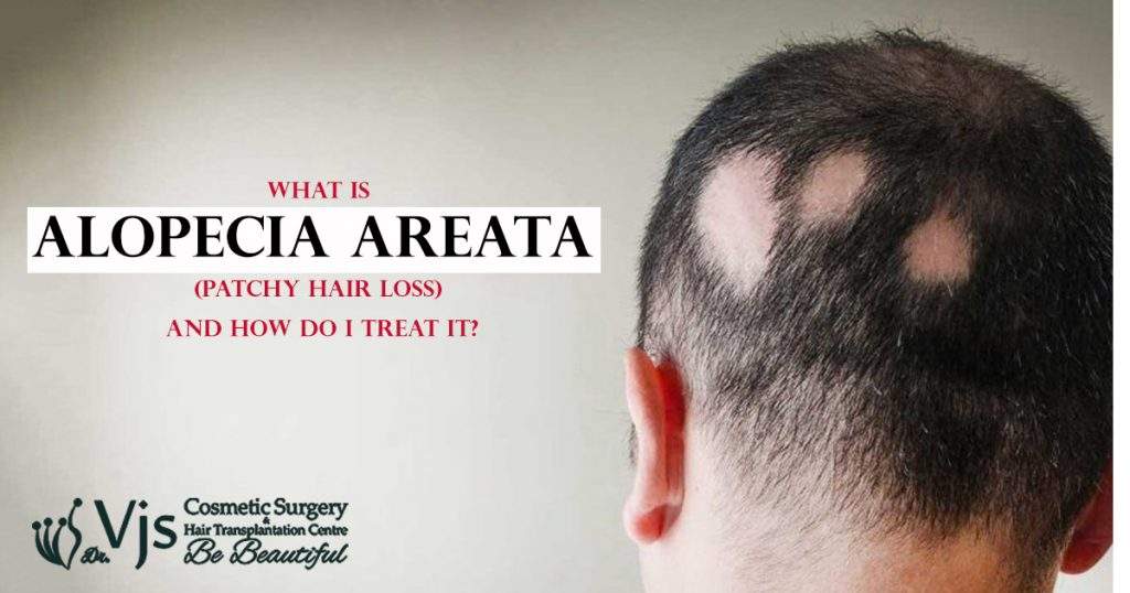 What Is Alopecia Areata (Patchy hair loss) and how do I Treat It?