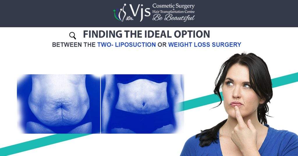 Liposuction or Weight loss surgery