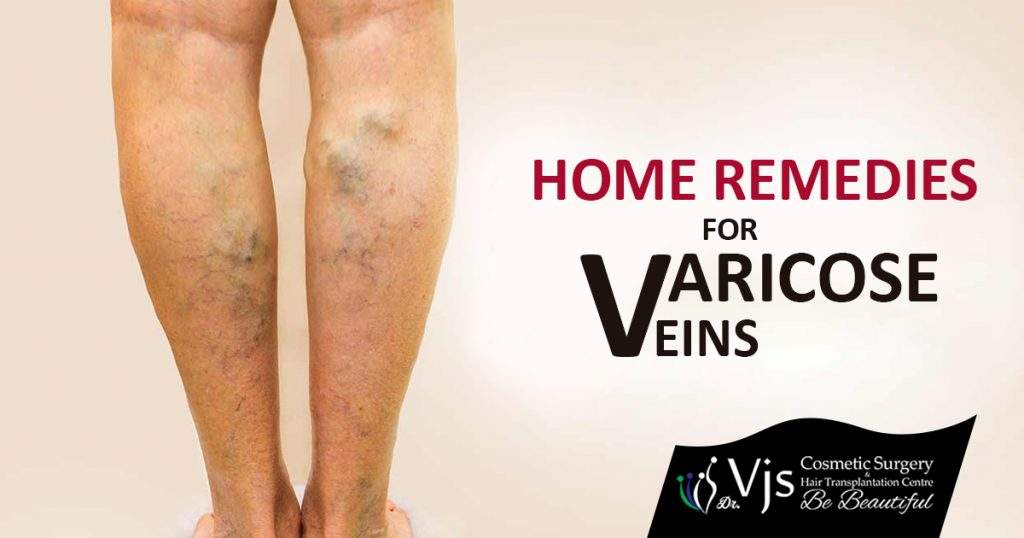 Home Remedies For Varicose veins