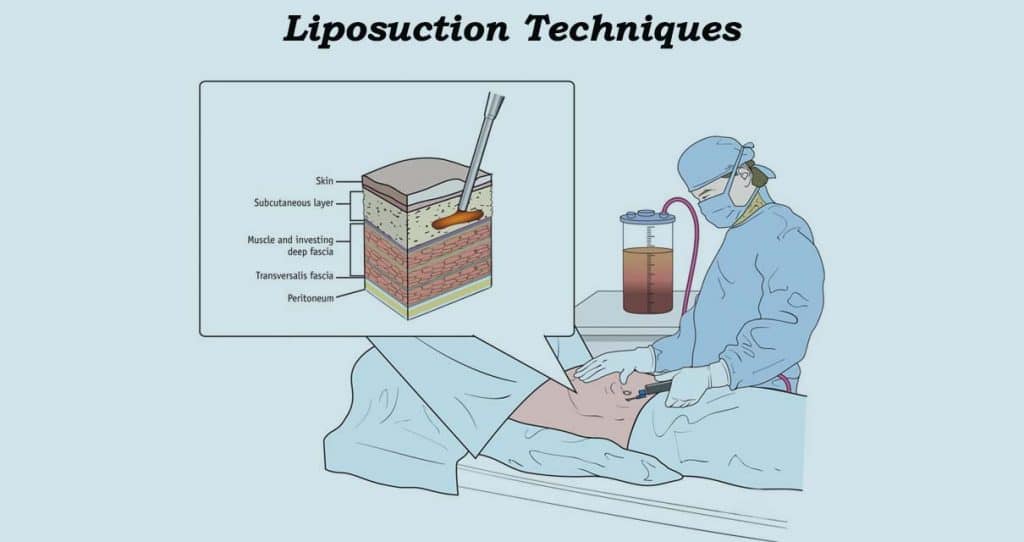 Liposuction Swelling
