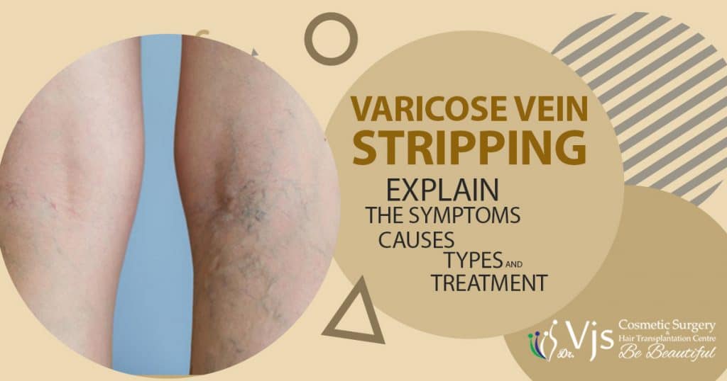 Varicose Vein Stripping: Explain the symptoms, causes, types, and treatment