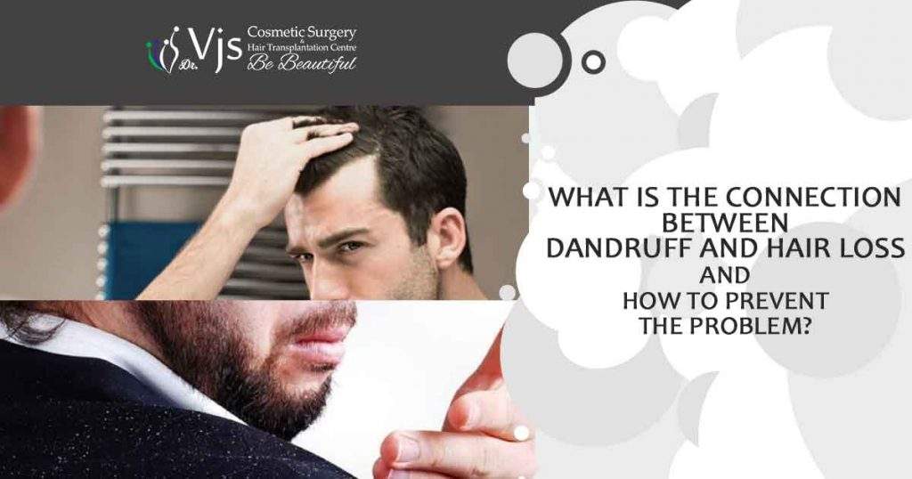 connection between Dandruff and Hair Loss