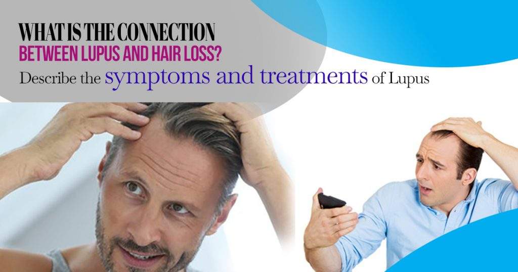 What is the connection between Lupus and Hair Loss? Describe the symptoms and treatments of Lupus?
