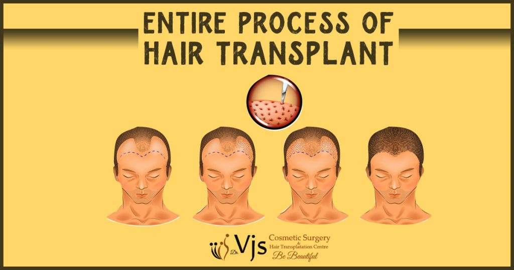 Entire-process-of-hair-transplant-