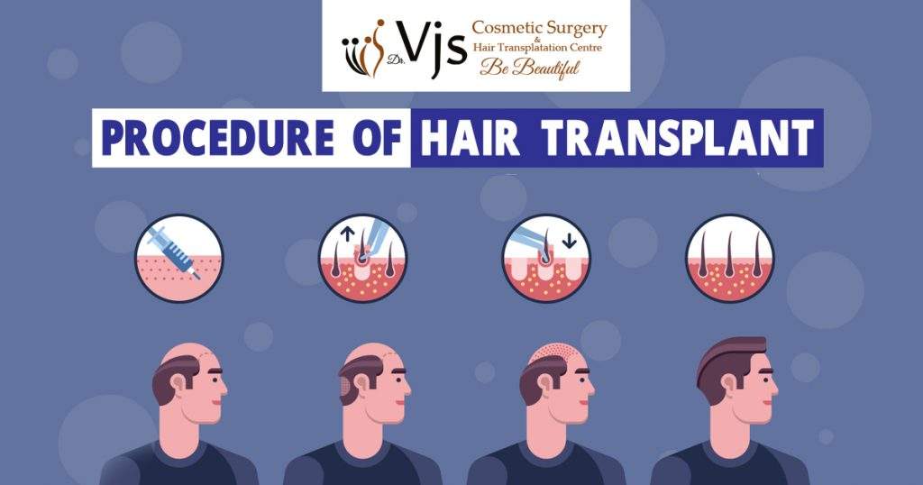 procedure of hair transplantation works