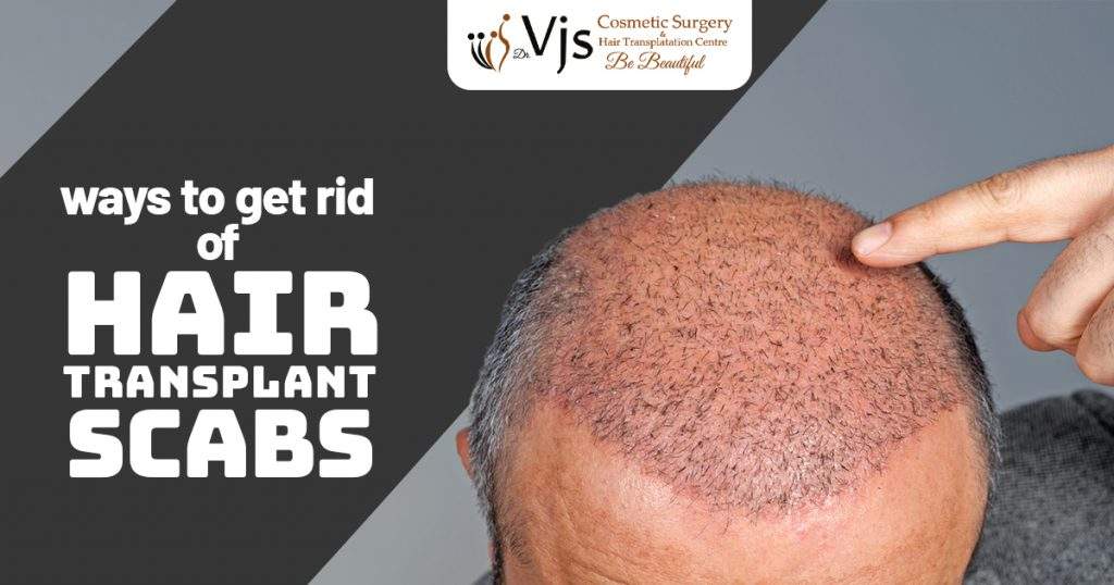 Hair transplant scabs and how to overcome this problem - Hair transplant  Dwaraka Nagar