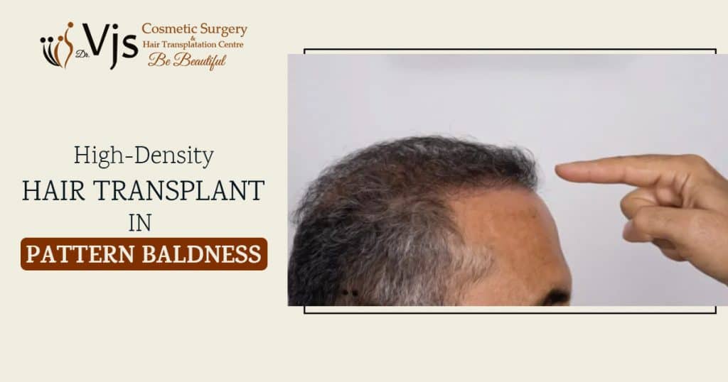 High-Density Hair Transplant For Male and Female Pattern Baldness