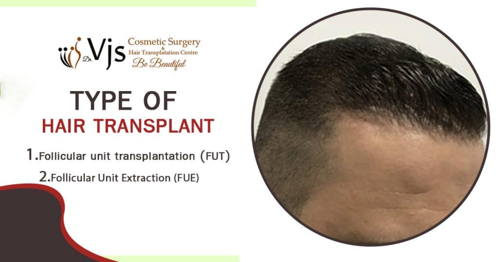 types of hair transplant along
