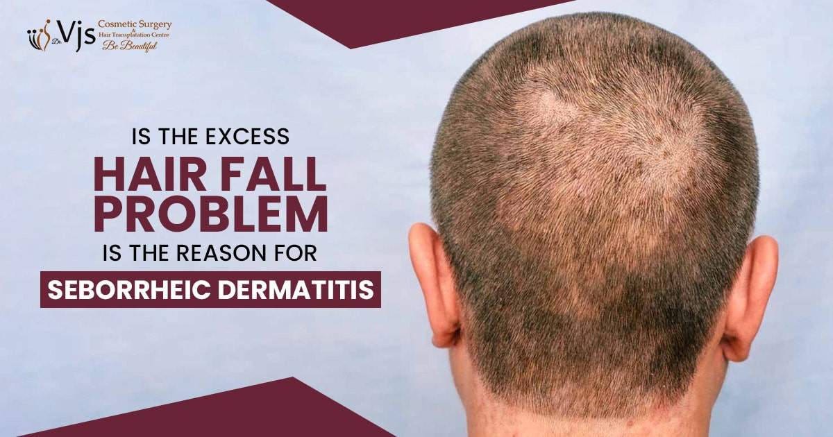 Is the excess hair fall problem is the reason for Seborrheic Dermatitis