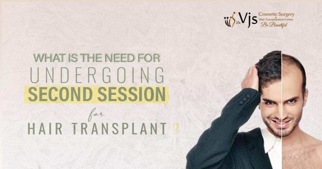 What is the need for undergoing the second session for hair transplant?