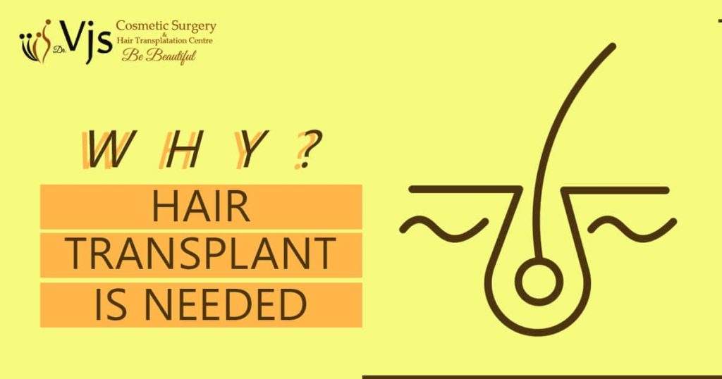 Why is hair transplant needed and explain the success rate of Hair Transplant?