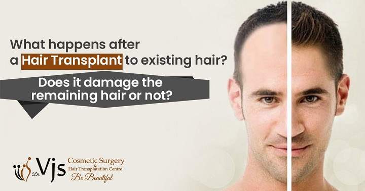 Myth or fact Does hair transplant damage the remaining hair or not?