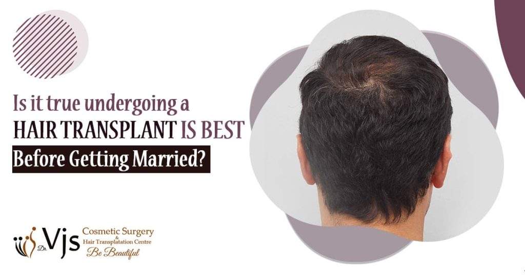 Is it true undergoing a hair transplant is best before getting married?
