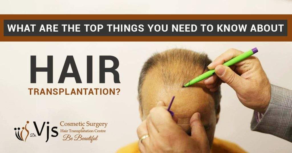What are the top things you need to know about hair transplantation?