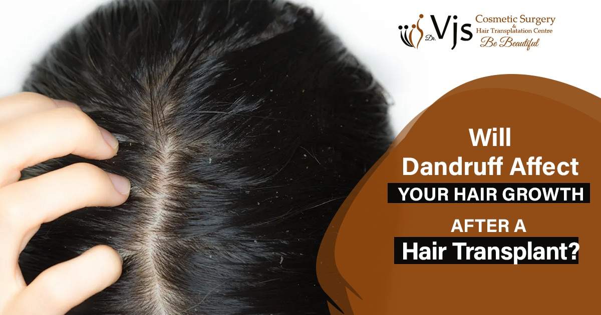 Will dandruff affect your hair growth after a hair transplant?