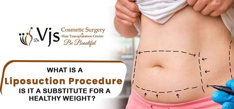 is it beneficial to undergo a liposuction procedure for weight loss?