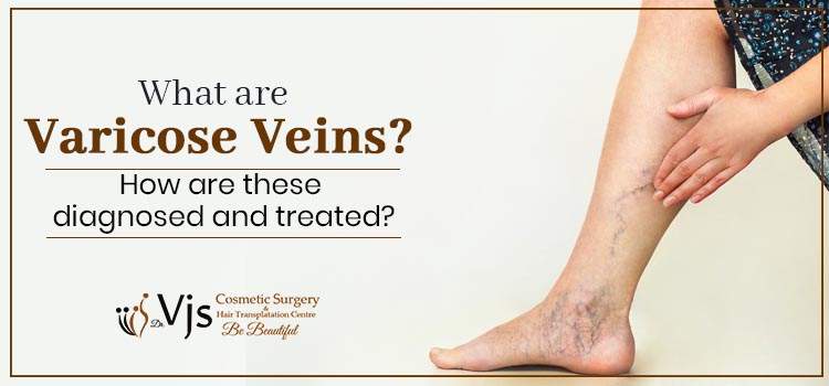 What are varicose veins? How are these diagnosed and treated?
