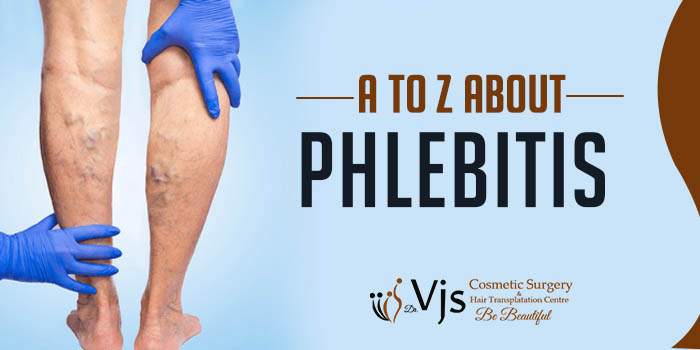 What is phlebitis? How is it caused and diagnosed? How is it treated?