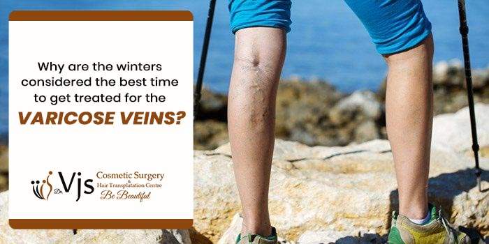 Why are the winters considered the best time to get treated for the varicose veins