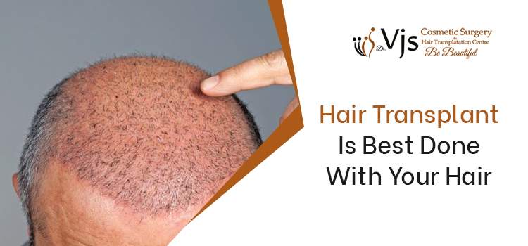 Hair-Transplant-Is-Best-Done-With-Your-Hair-vj-clinic