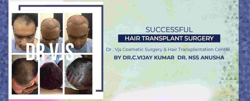 What are the various reasons when and why men need Hair Transplant Surgery