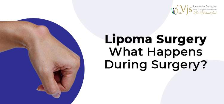 Lipoma Surgery What Happens During Surgery