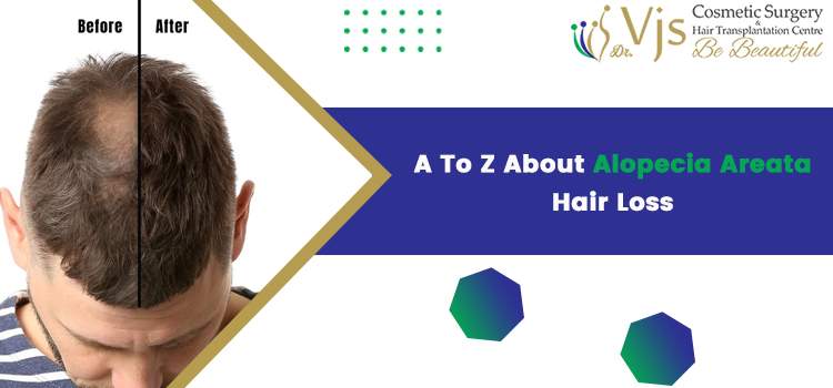 A To Z About Alopecia Areata Hair Loss