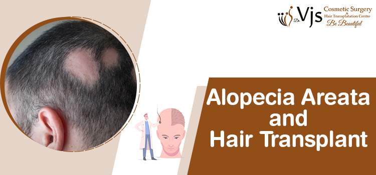 Does Hair transplant treatment work best for alopecia areata?