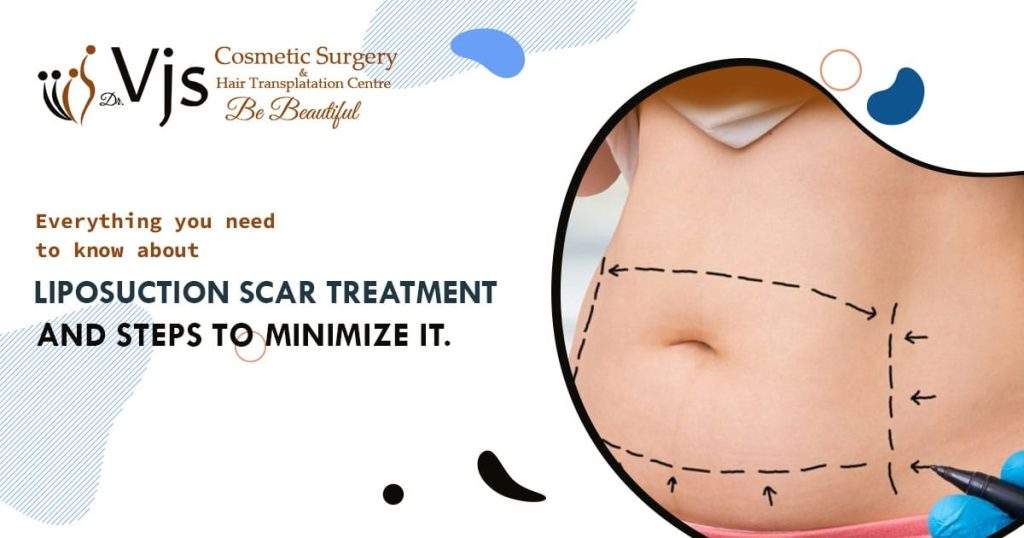 Everything you need to know about liposuction scar treatment and steps to minimize