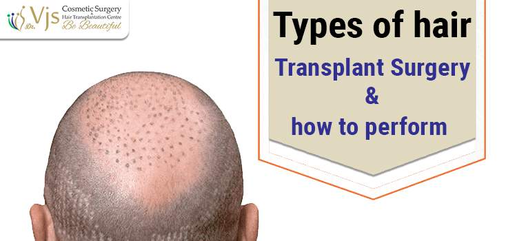 Types of hair transplant Surgery and how to perform