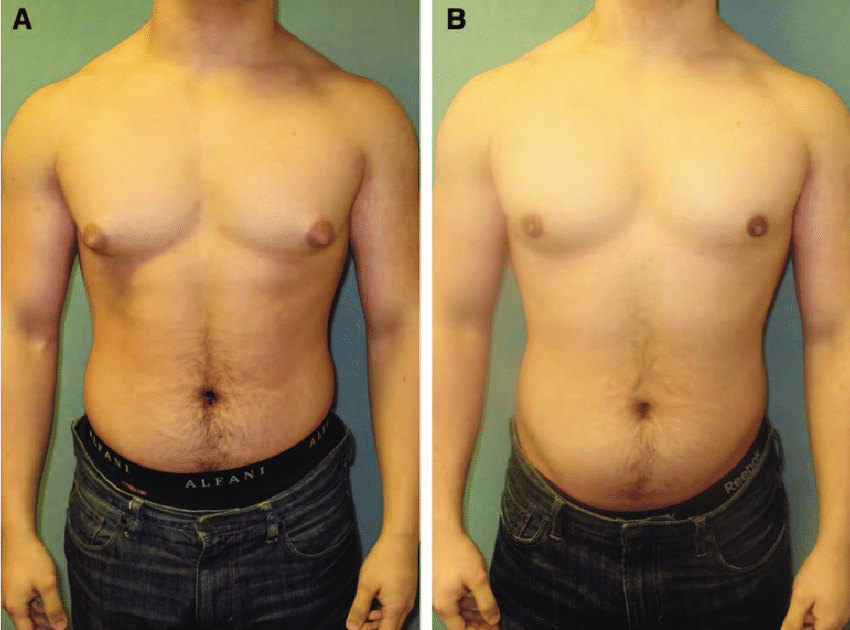 gynecomastia surgery Before & After Results