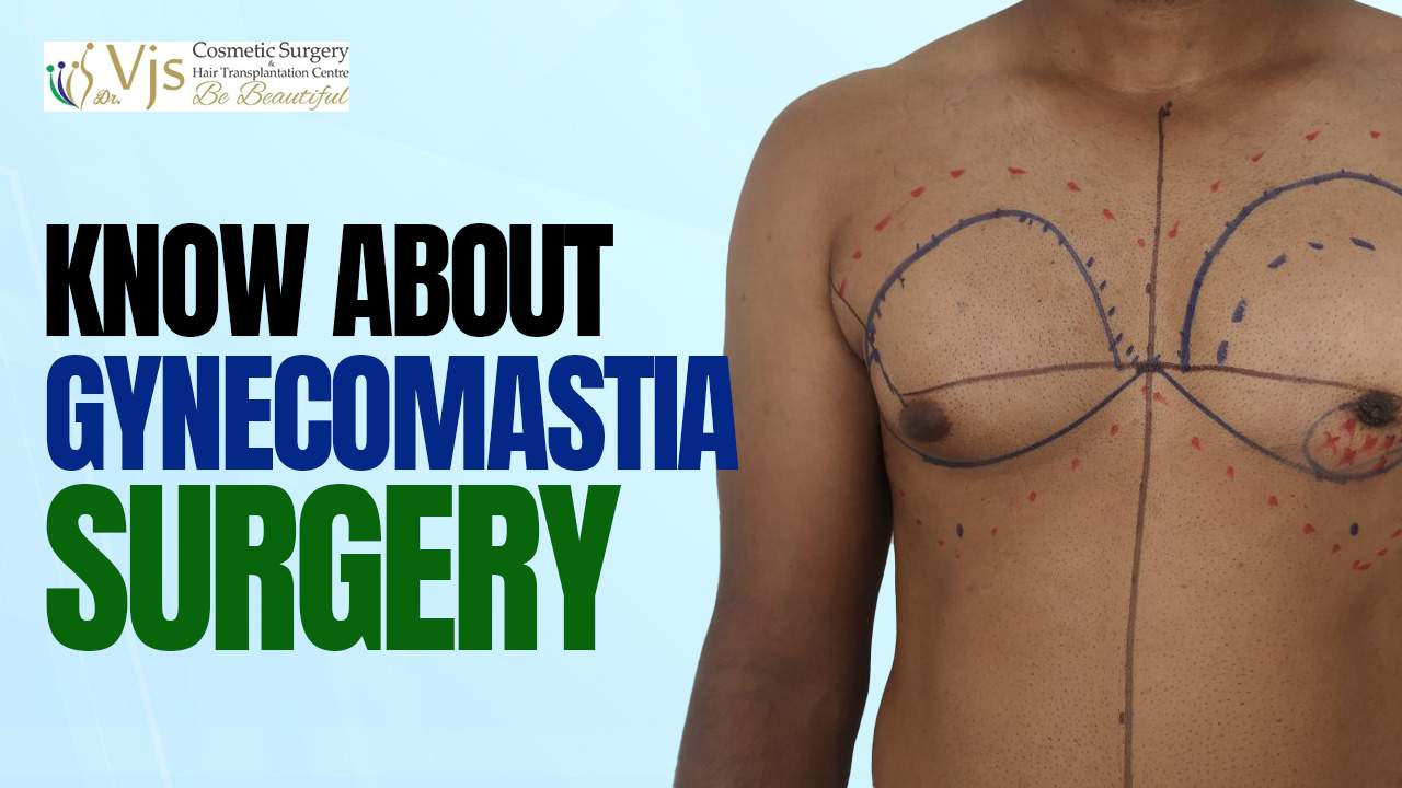 What You Should Know About Gynecomastia