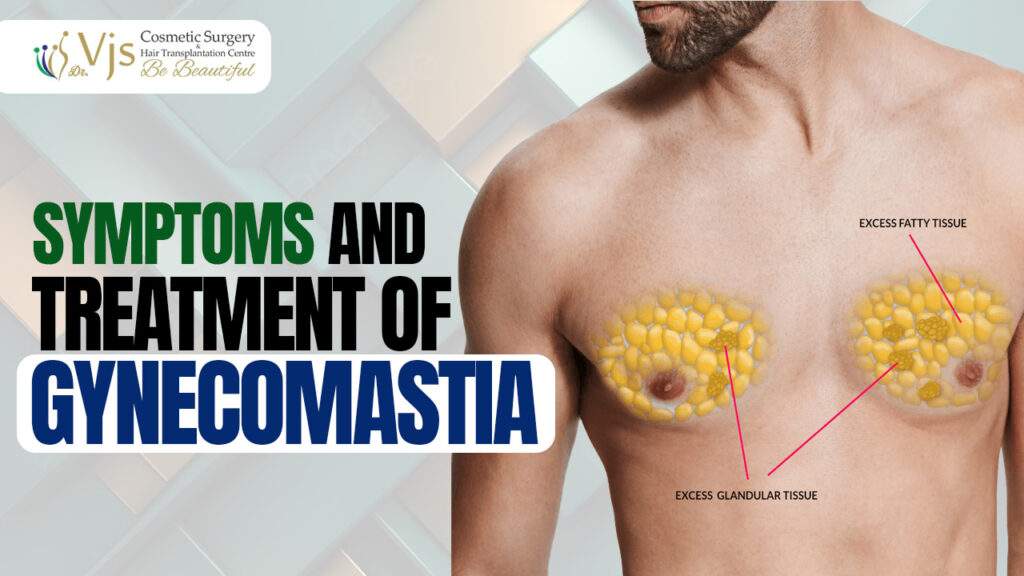 What is Gynecomastia Type ? Causes, Symptoms and Treatment