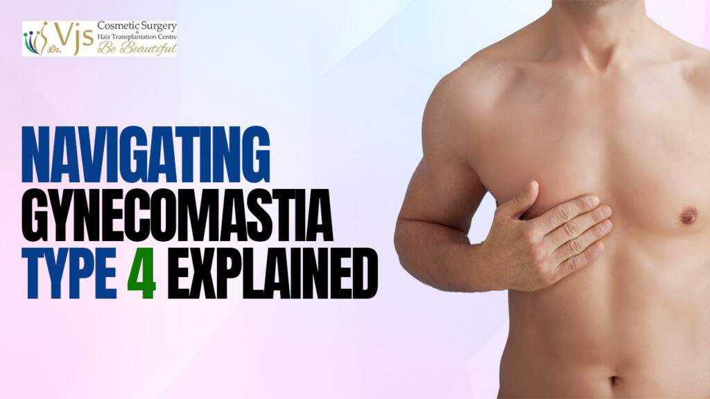 What You Should Know About Gynecomastia – Type 4