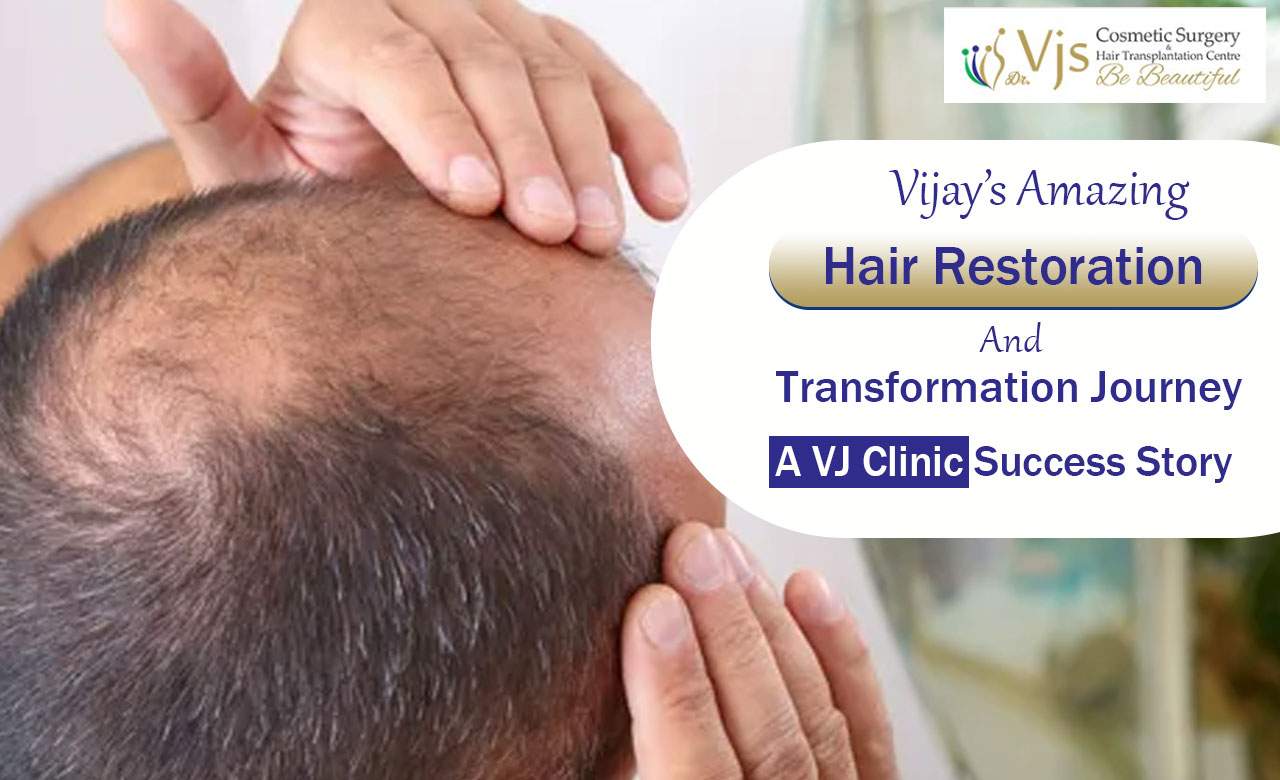 Vijay’s Amazing Hair Restoration And Transformation Journey: A VJ Clinic Success Story