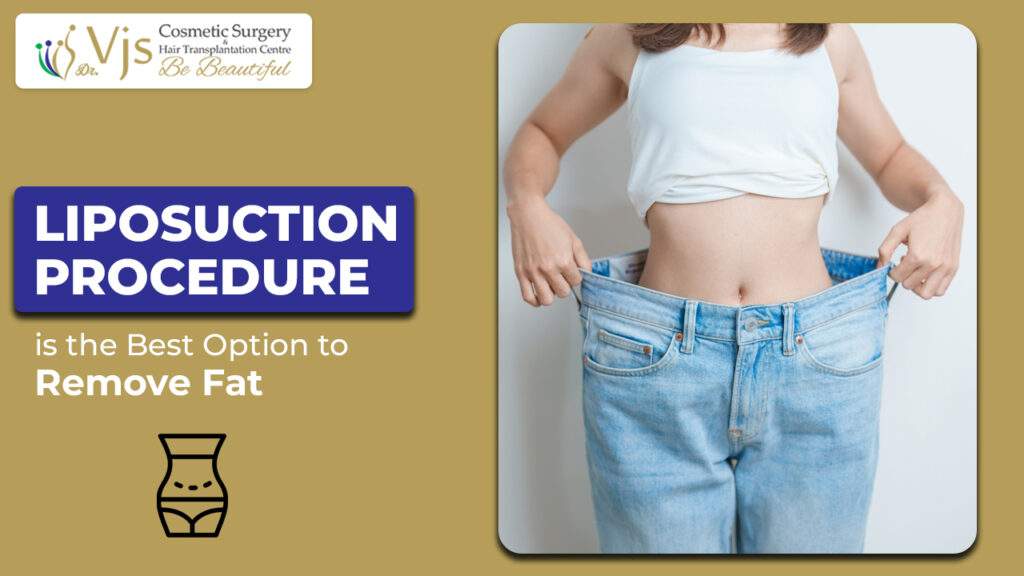 Liposuction Procedure is the Best Option to Remove Fat