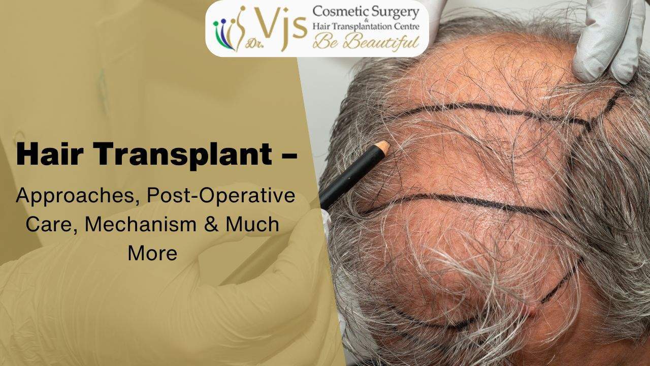 Hair Transplant – Approaches, Post-Operative Care, Mechanism & Much More
