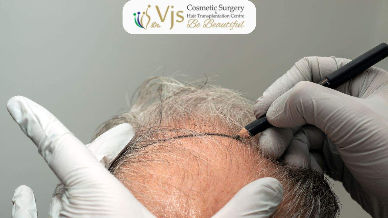 Natural hair transplantation procedure at VJ Clinics, expert hair restoration services.