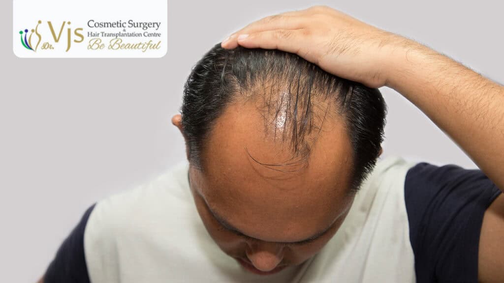 Causes and Treatment of Telogen Effluvium – Understanding Sudden Hair Loss