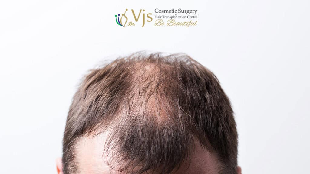 Regain Hair Health: Benefits of Quitting Smoking for Hair Growth