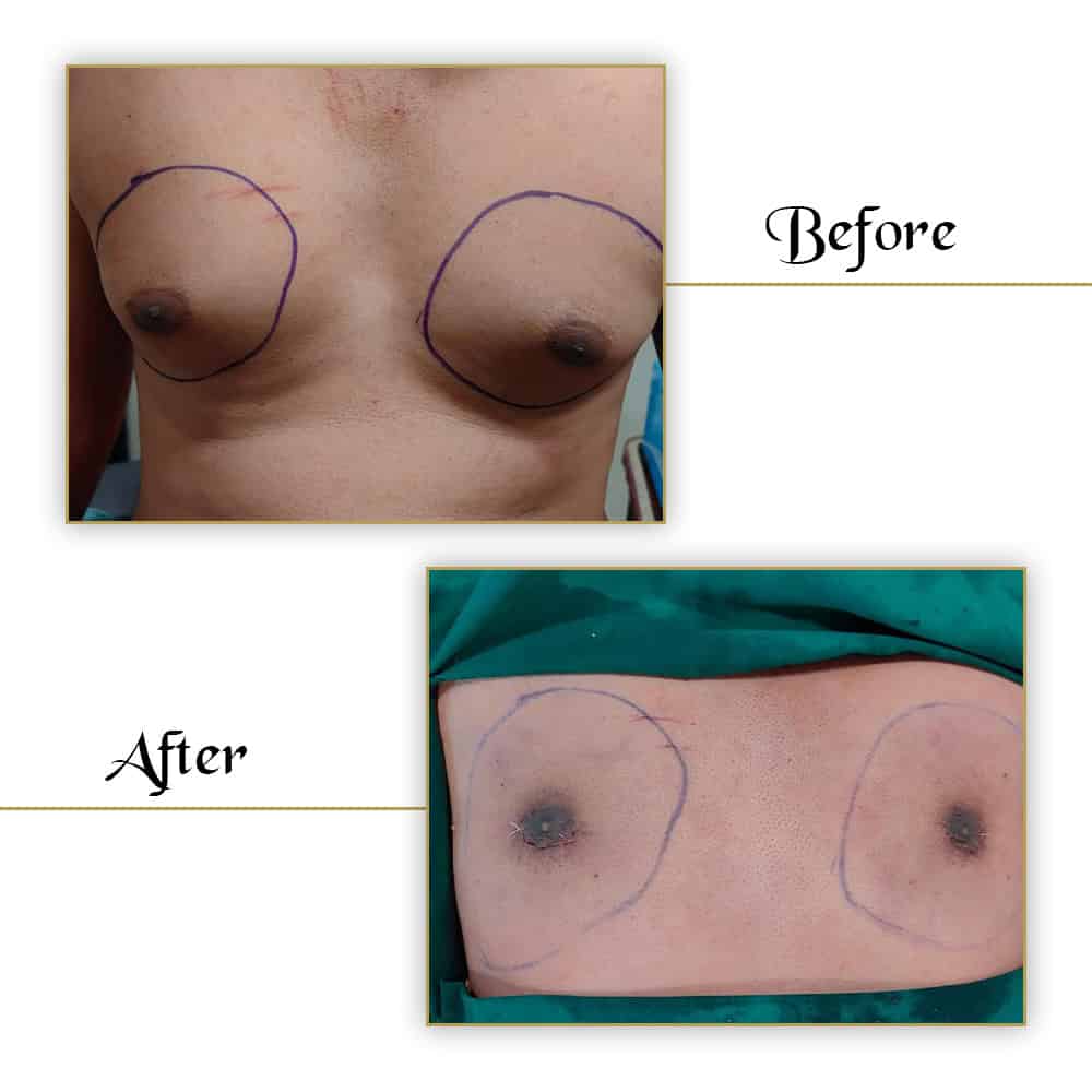 Breast augmentation before and after surgery VJ Clinics, natural-looking results, surgical breast enhancement, cosmetic surgery images.