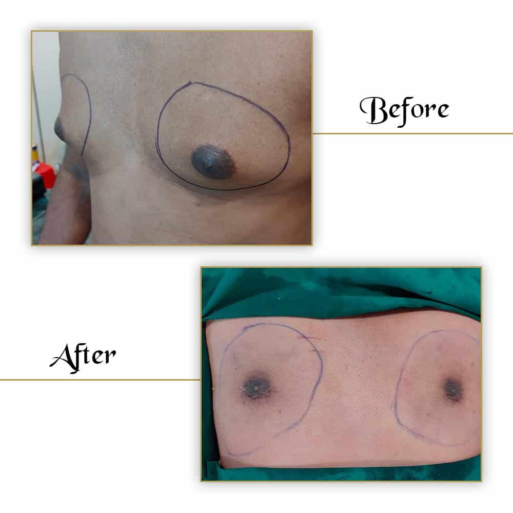 Chest reconstruction before and after breast surgery at VJ Clinics, showing detailed surgical results.
