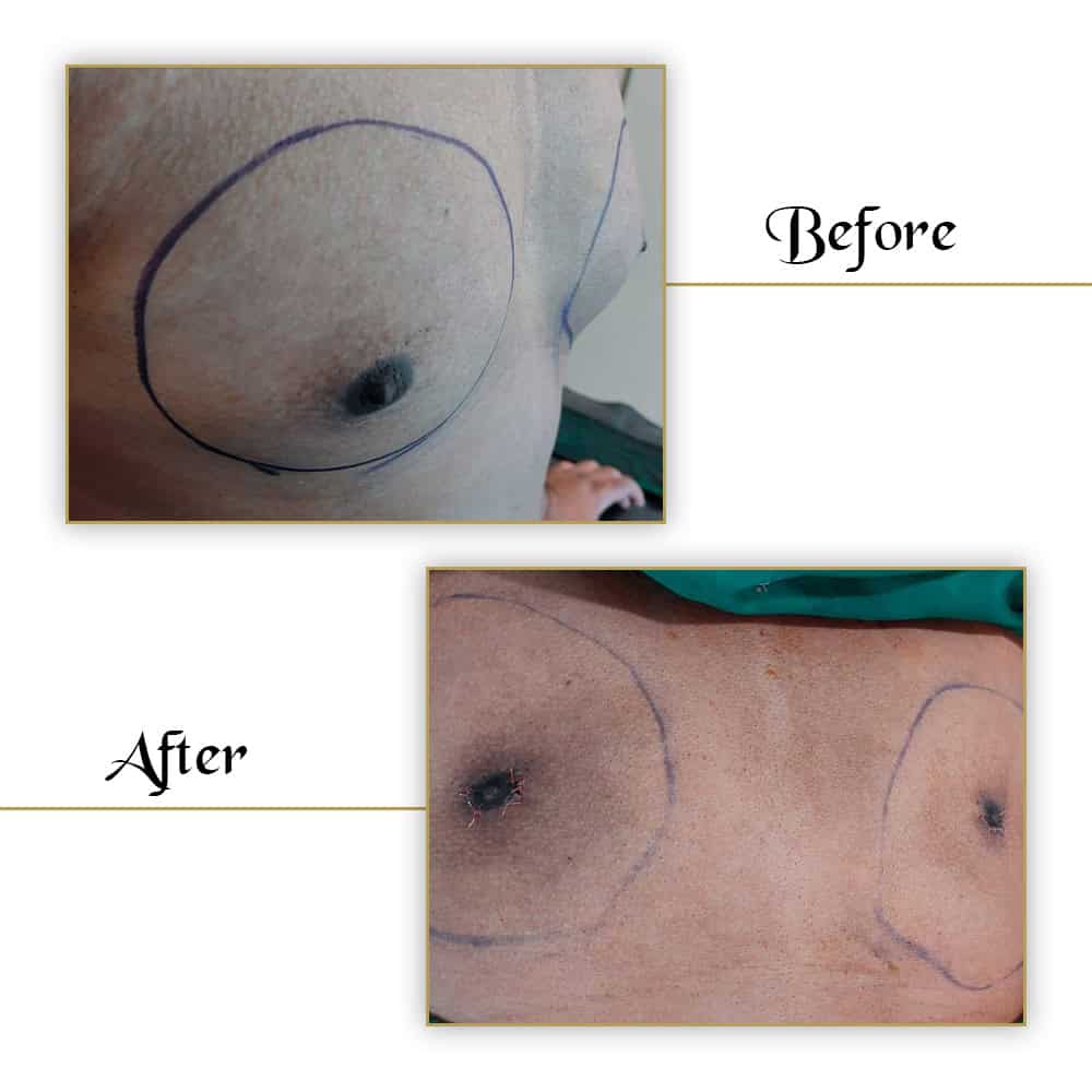 Scar correction before and after images for VJ Clinics breast augmentation procedure.