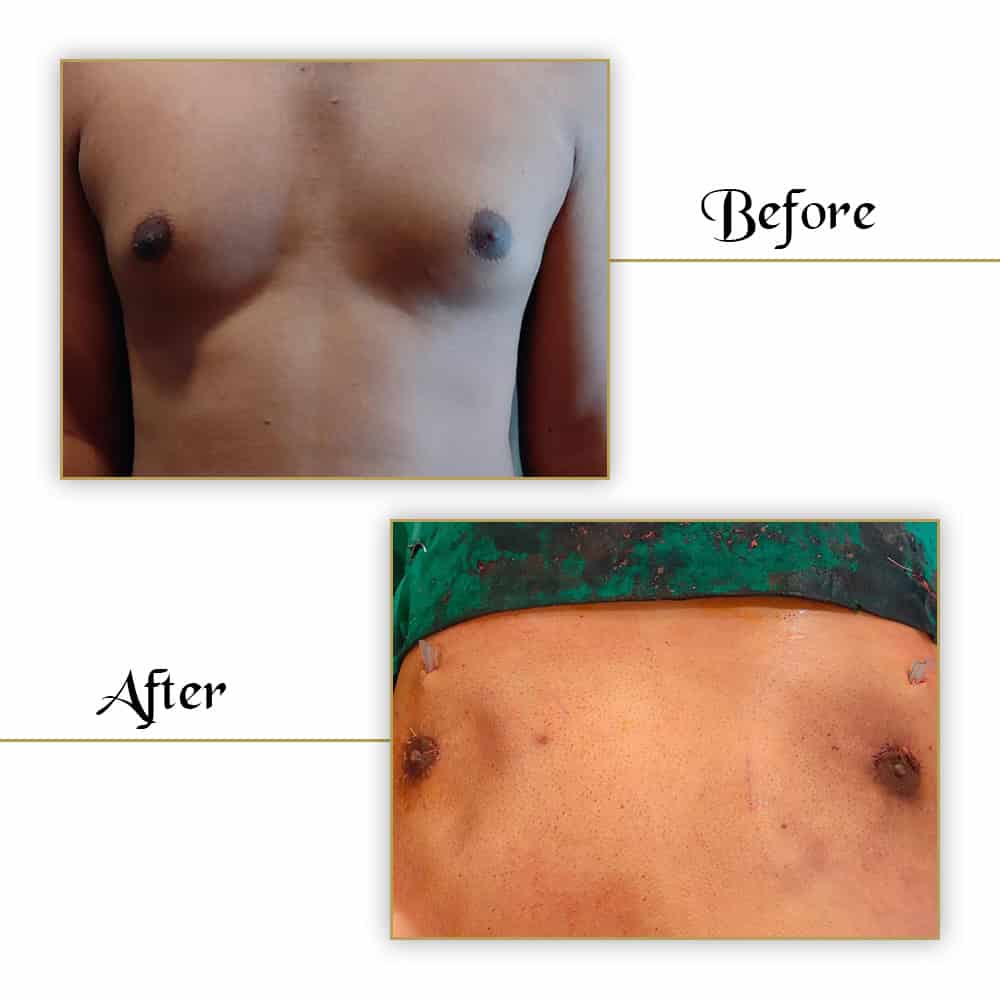 Nude male chest before and after surgical enhancement, showing improved skin tone and contour.
