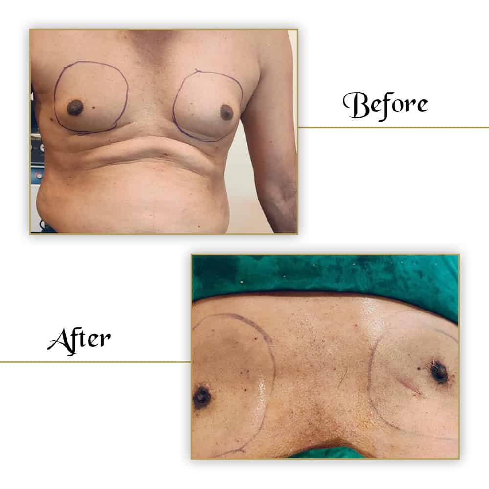 Scar removal and skin tightening after VJ Clinics breast surgery procedure.